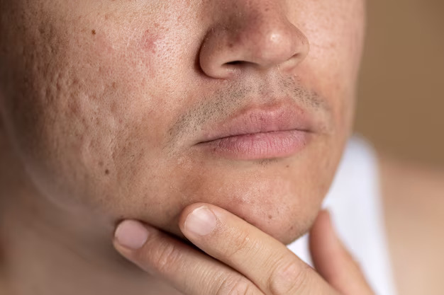 a person with acne scars and large pores