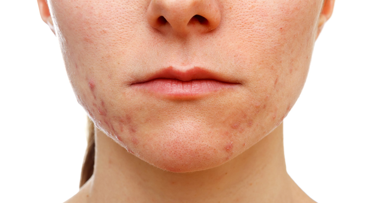 Acne Marks Vs Acne Scars Differences Treatments Sozo Clinic