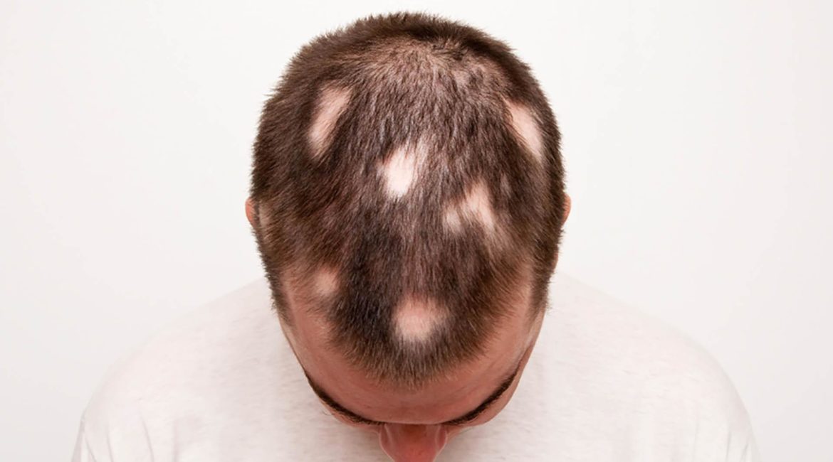 Alopecia Areata Treatment in Singapore: Price, Reviews, FAQs