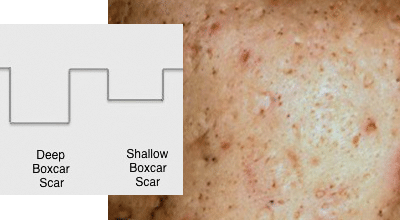 boxcar scars