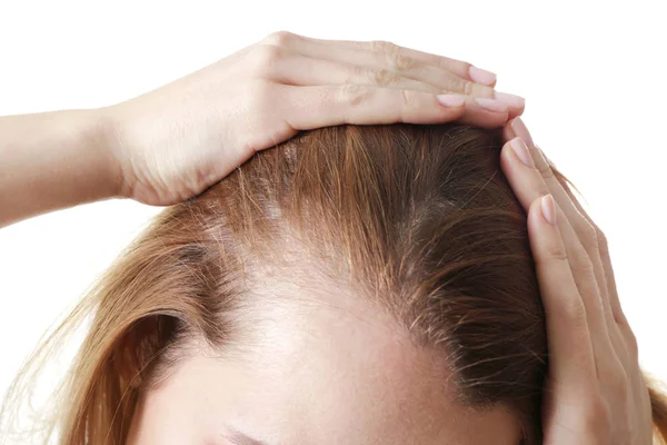 female hair loss