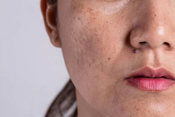 Who Is Pigmentation Treatment For?​