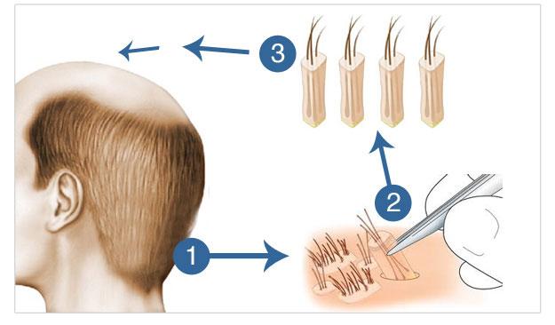 FUE (Follicular Unit Extraction) Hair transplant