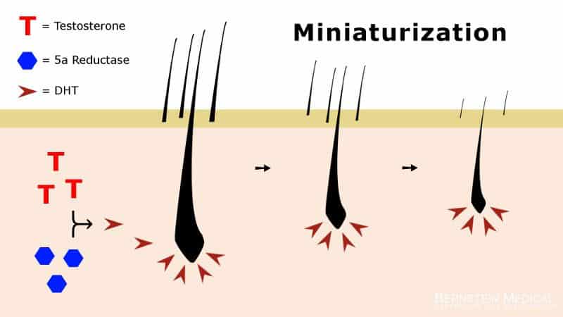 hair loss diagram
