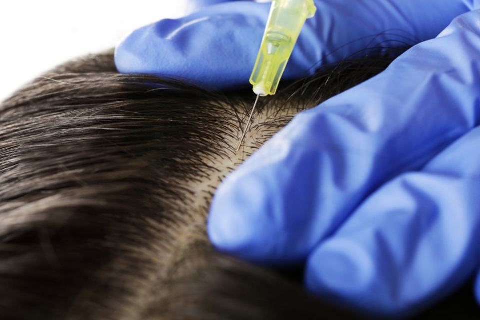hair loss treatment -scalp receiving injections