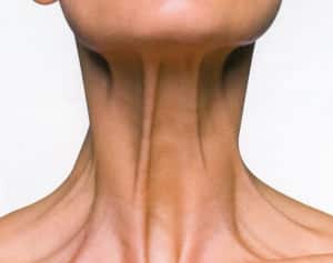 how to get rid of double chin age