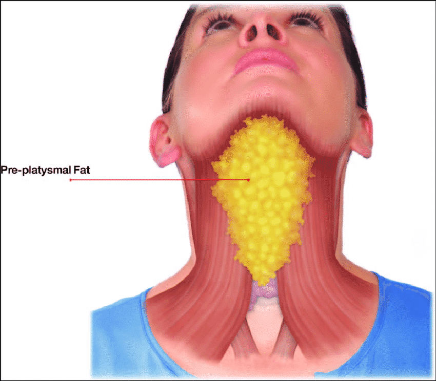 how to get rid of double chin diet and lifestle