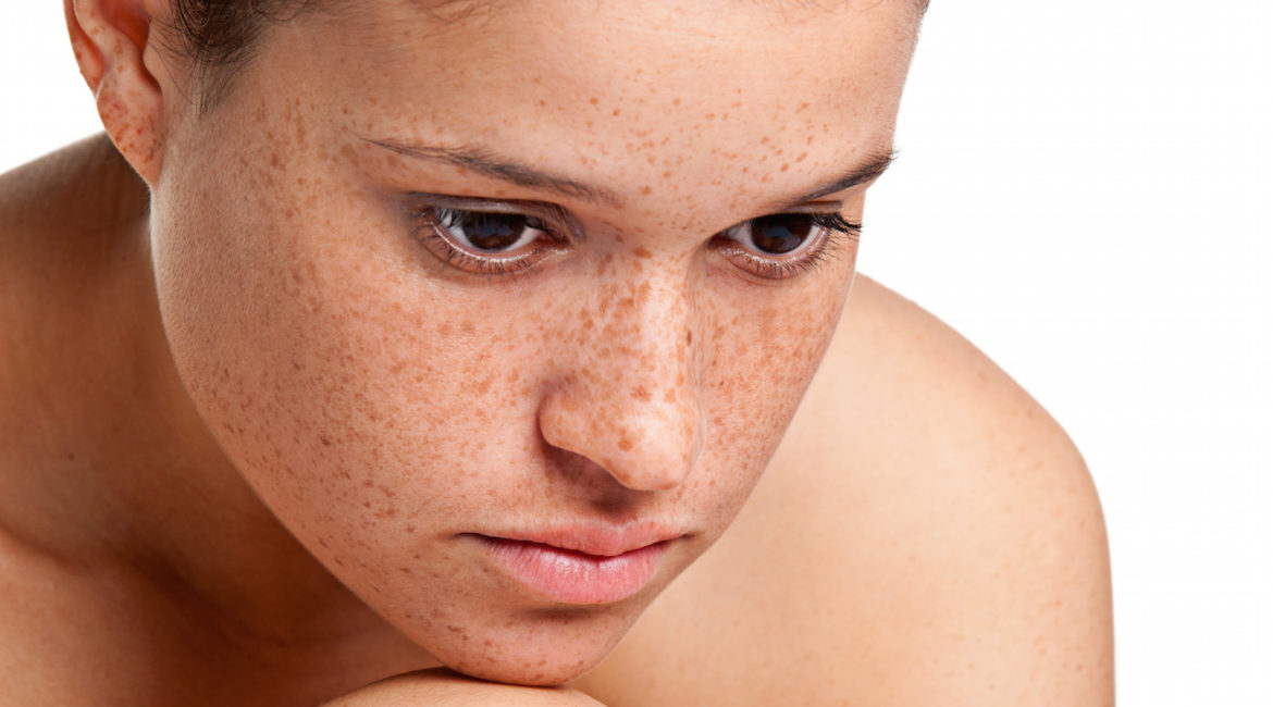 how to get rid of freckles in singapore