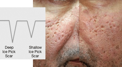 ice pick scar