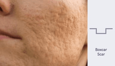 Boxcar Scars