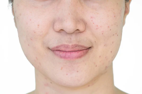 How Can Post-Inflammatory Erythema Be Prevented?