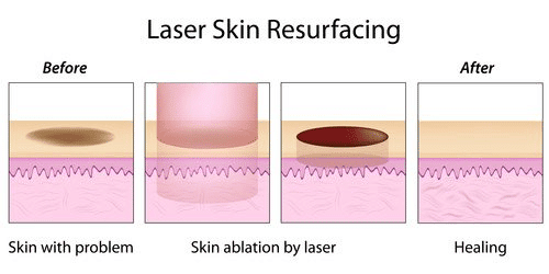 Laser Skin Resurfacing