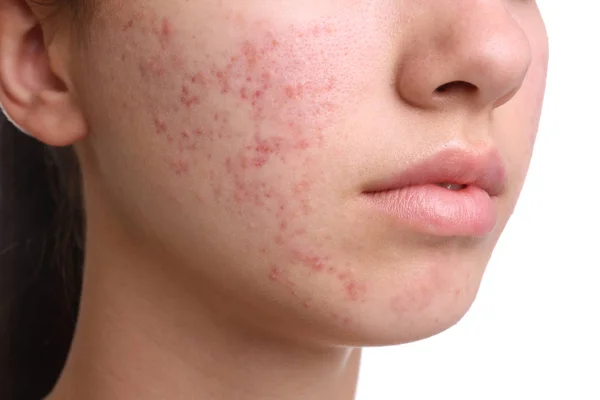 Post-Inflammatory Erythema