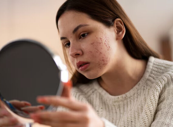 a woman dealing with teenage acne