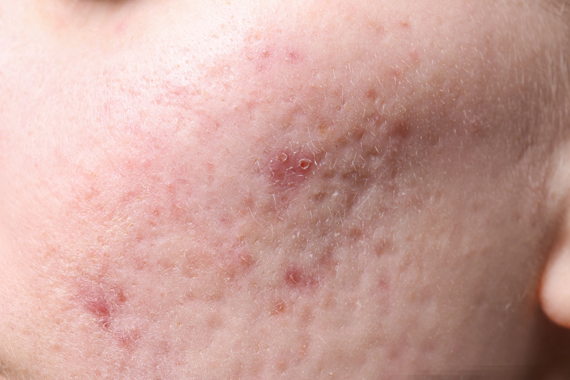 Do Pitted Acne Scars Fade Over Time