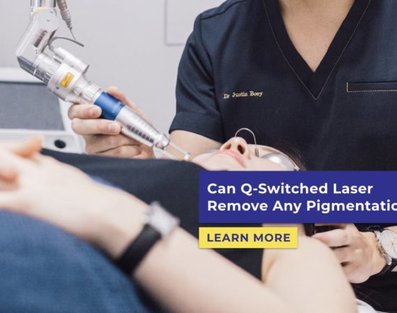 q switched laser pigmentation