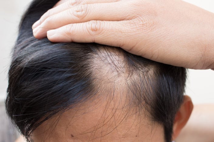 receding frontal line male hair loss