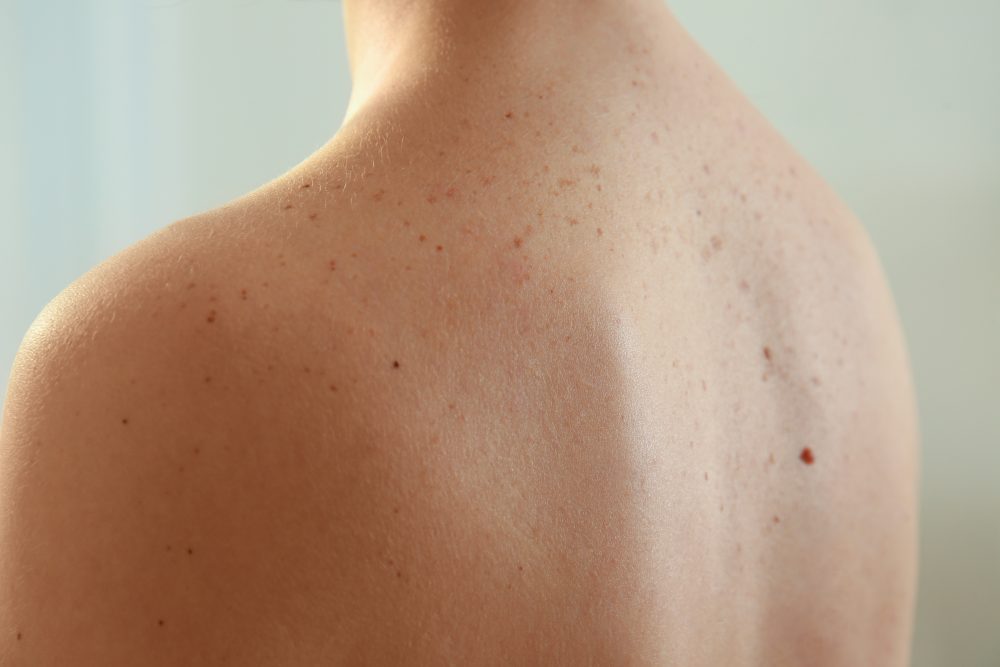 remove body freckles in singapore