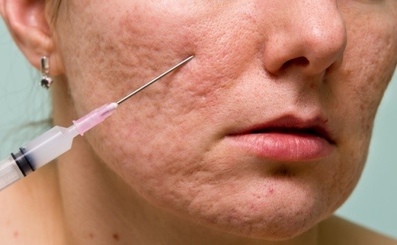 subcision acne scar benefits