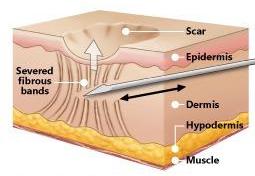 what is subcision for acne scar treatment