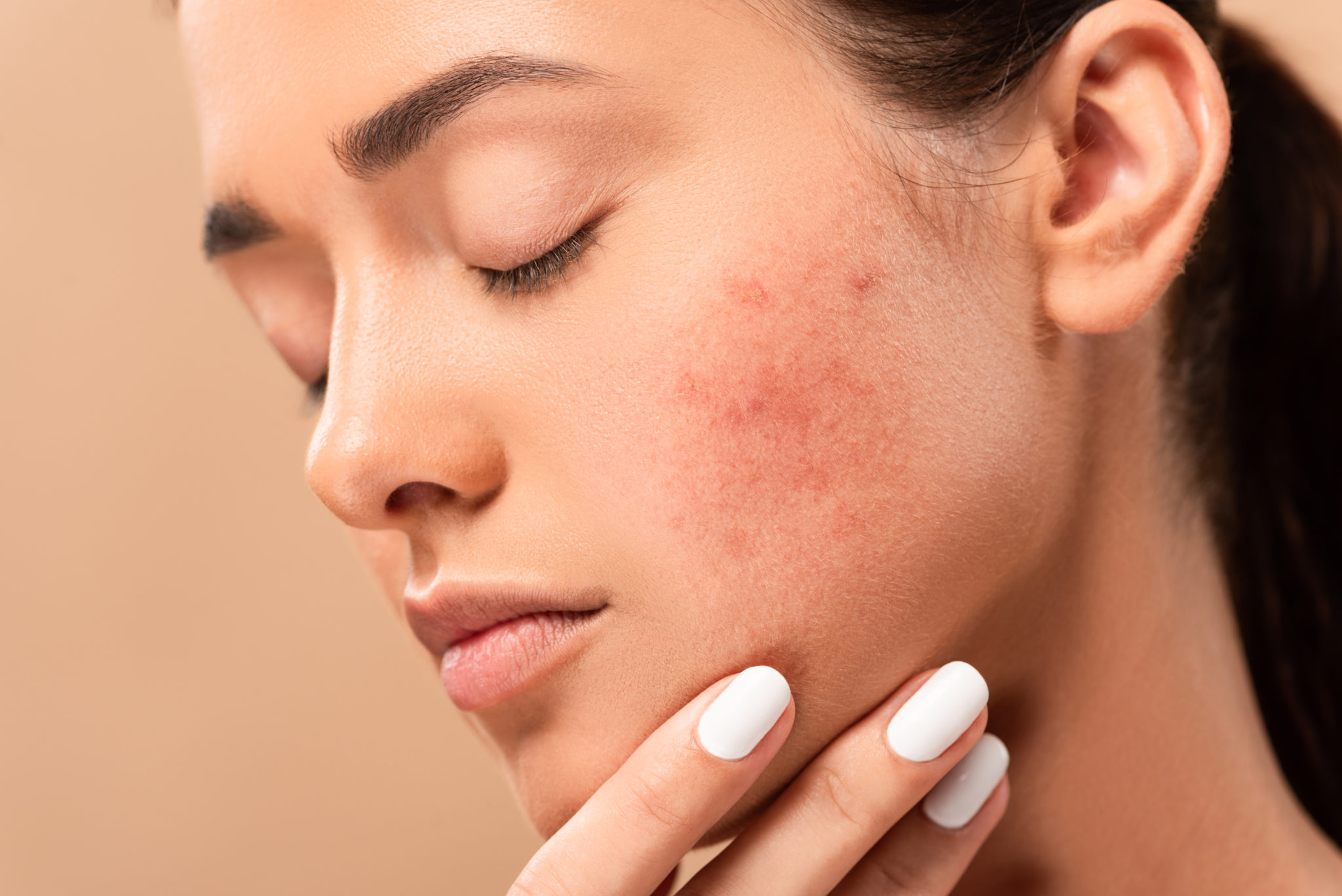 How Reduce Redness from Acne | Sozoclinic
