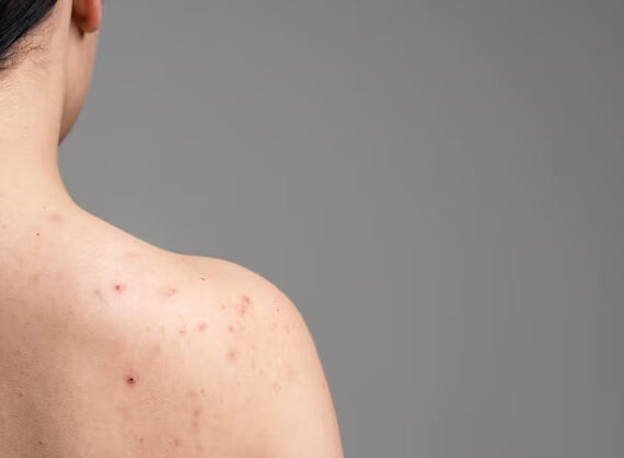Young woman showing the back acne scars and acne